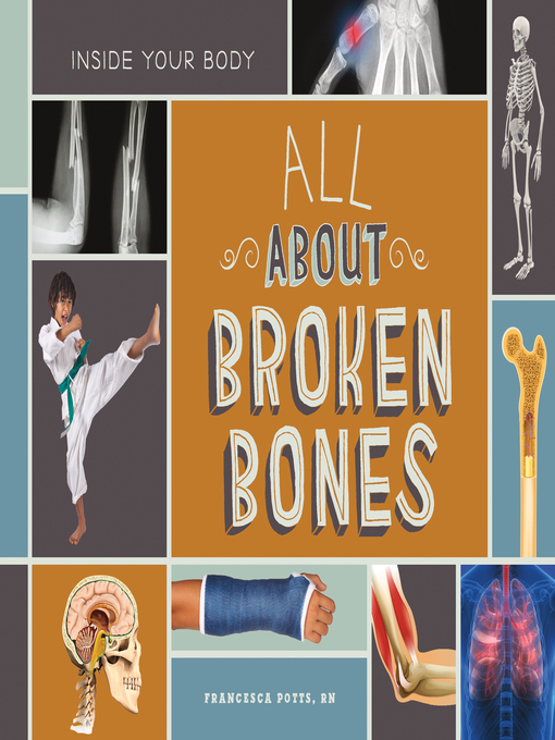 Title details for All About Broken Bones by Francesca Potts, RN - Available